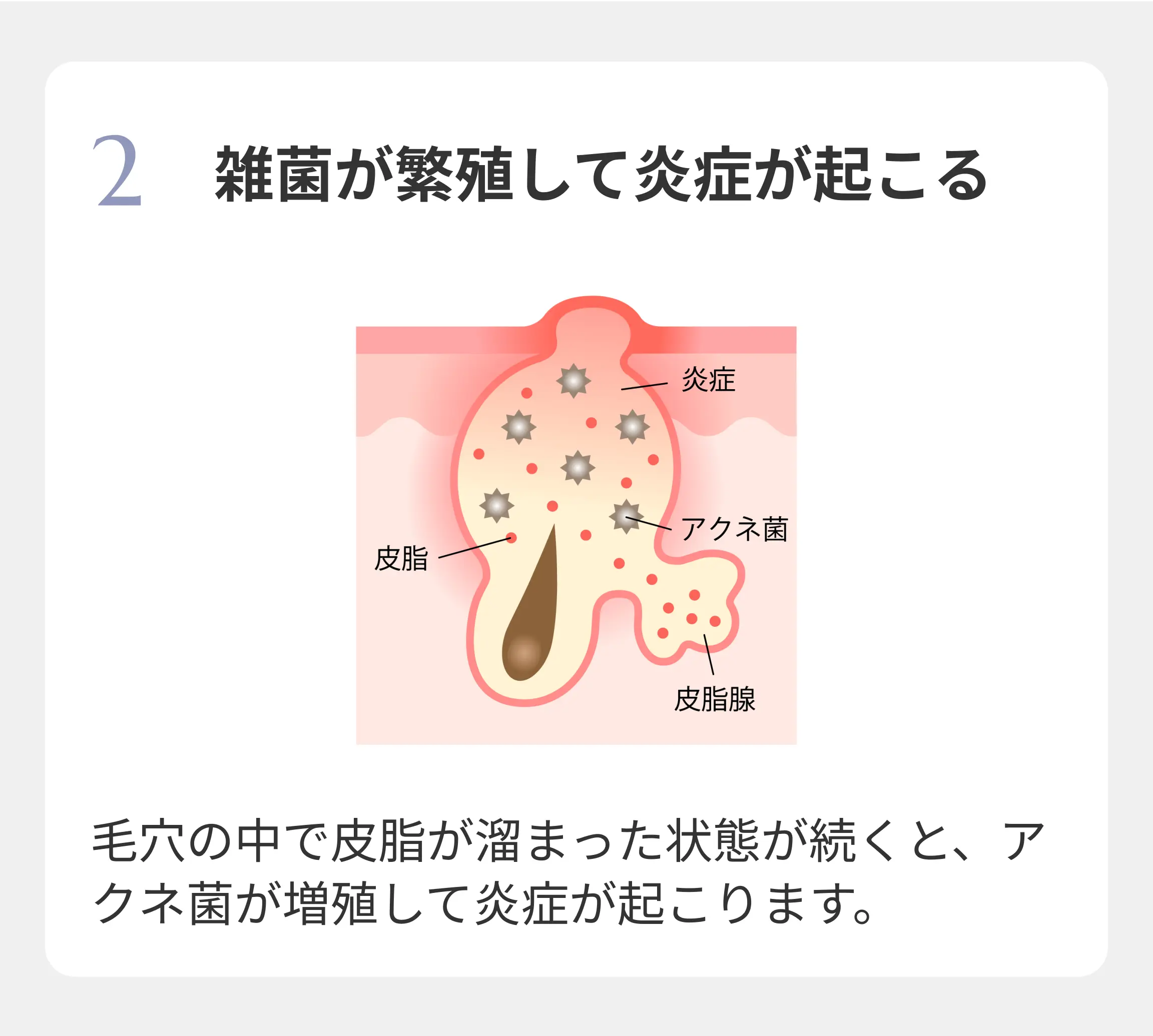 雑菌が繁殖して炎症が起こる